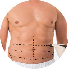 Мужская абдоминопластика