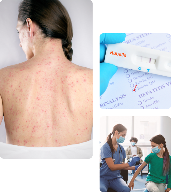 Осложнения после вакцинации от краснухи