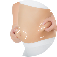 Липомоделирование тела