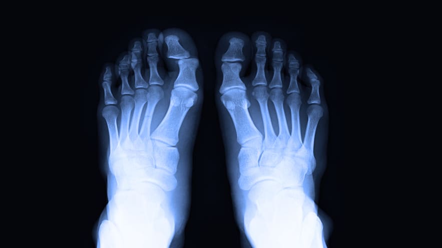 Показания для корригирующей остеотомии стопы Показания для корригирующей остеотомии стопы