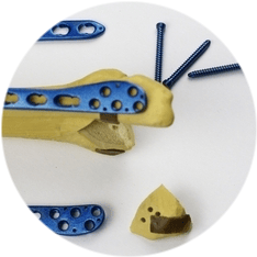 Остеосинтез костей Остеосинтез костей