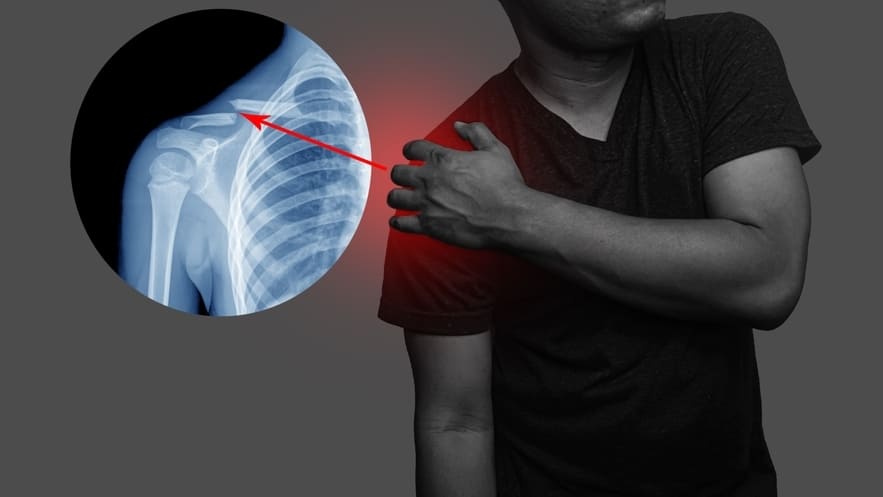 Перелом ключицы Показания к проведению остеосинтеза ключицы