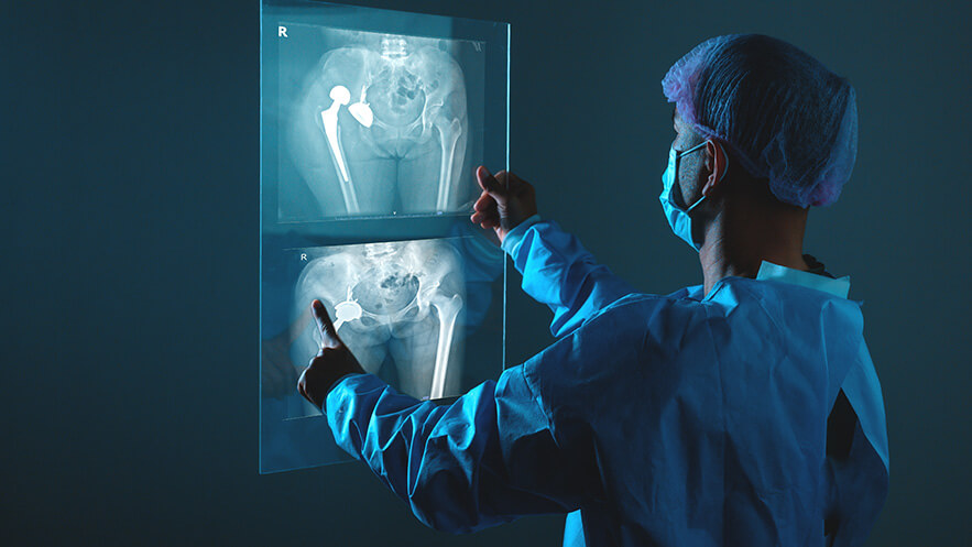 Врач консультирует пациента по эндопротезированию тазобедренного сустава Показания к эндопротезированию тазобедренных суставов