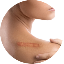 Пластика рубцов