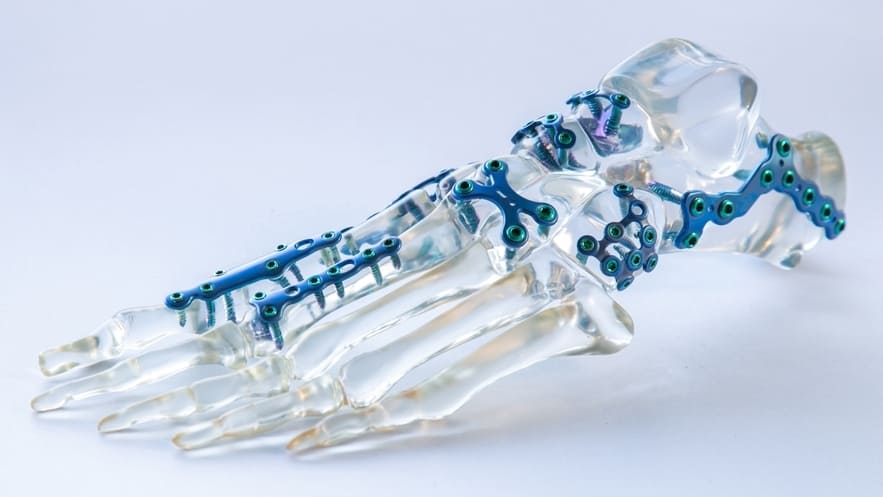 Репозиция костных фрагментов запястья Показания к остеосинтезу запястья