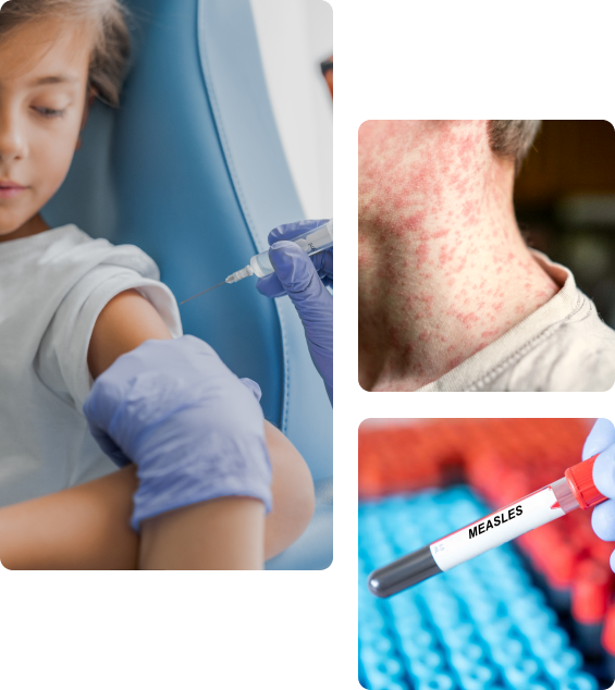 Осложнения после прививки от кори