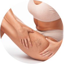 Склеротерапия вен Склеротерапия вен