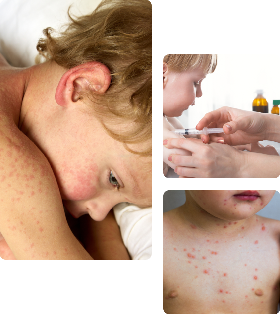 Осложнения после прививки от краснухи детям