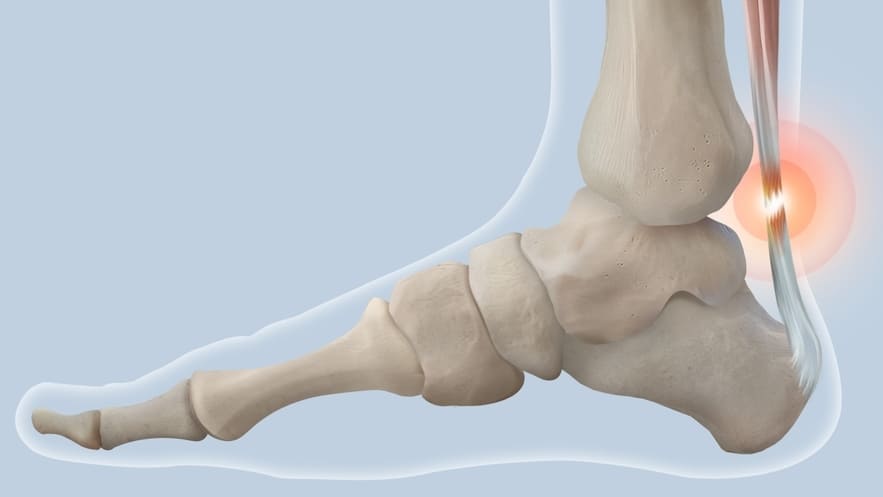 Показания к операции шов сухожилия