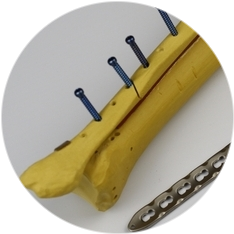 Остеосинтез ключицы Остеосинтез ключицы