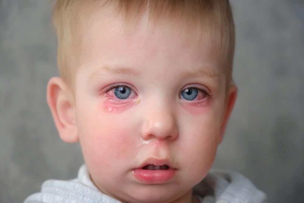 Аллергический конъюнктивит у детей