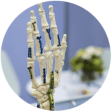 Остеосинтез пястной кости