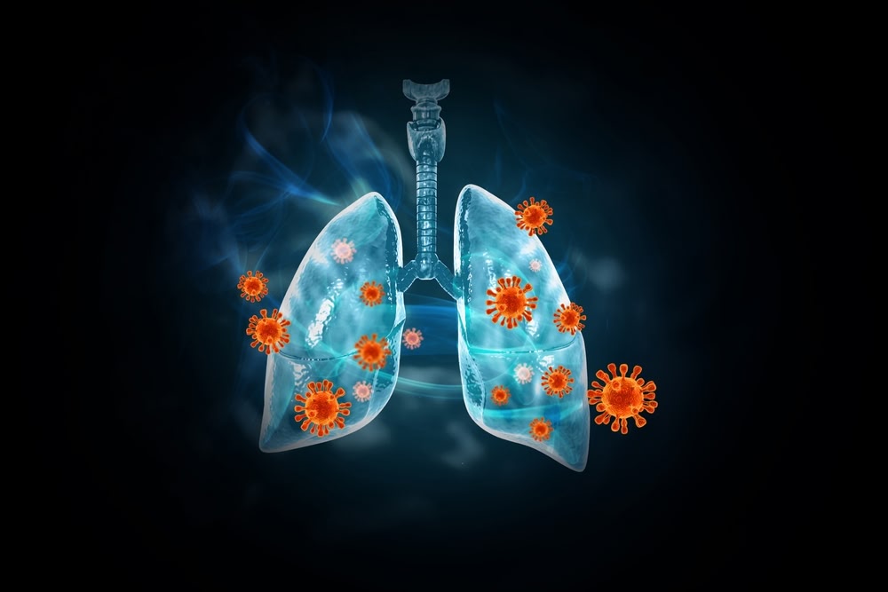 Бактериальная пневмония