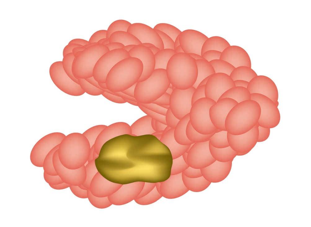 Киста слюнной железы