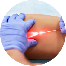 Удаление сосудистых звёздочек на ногах лазером