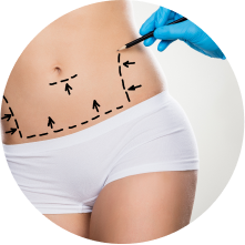 Миниабдоминопластика