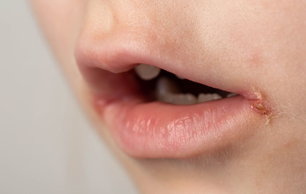 Пиодермия у детей