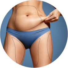 Липосакция живота