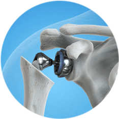 Эндопротезирование плечевого сустава