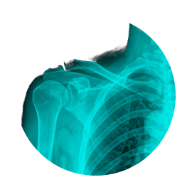 МРТ мягких тканей плеча