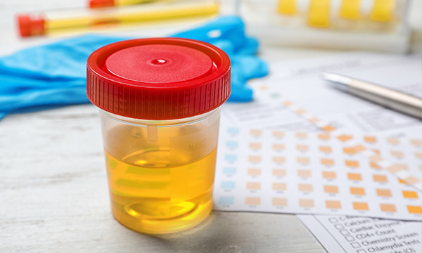 Исследование уровня калия в моче (ион-селективным методом, суточная порция) Исследование уровня калия в моче (ион-селективным методом, суточная порция)