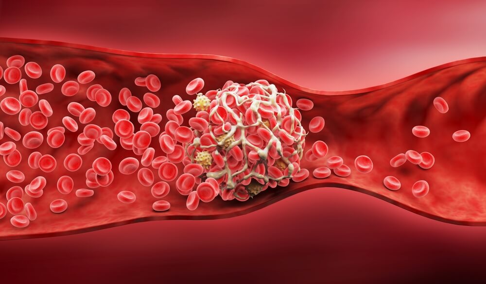 Образование тромба в кровеносном сосуде Тромбофилия