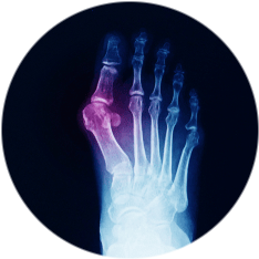 Остеотомия Scarf Остеотомия Scarf