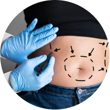 Липосакция Липосакция