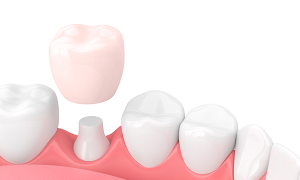 Снятие зубной коронки