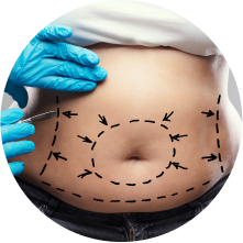 Липофилинг