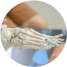 Остеосинтез плюсневой кости стопы Остеосинтез плюсневой кости стопы