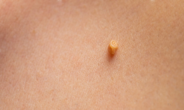 Удаление кондилом Удаление кондилом