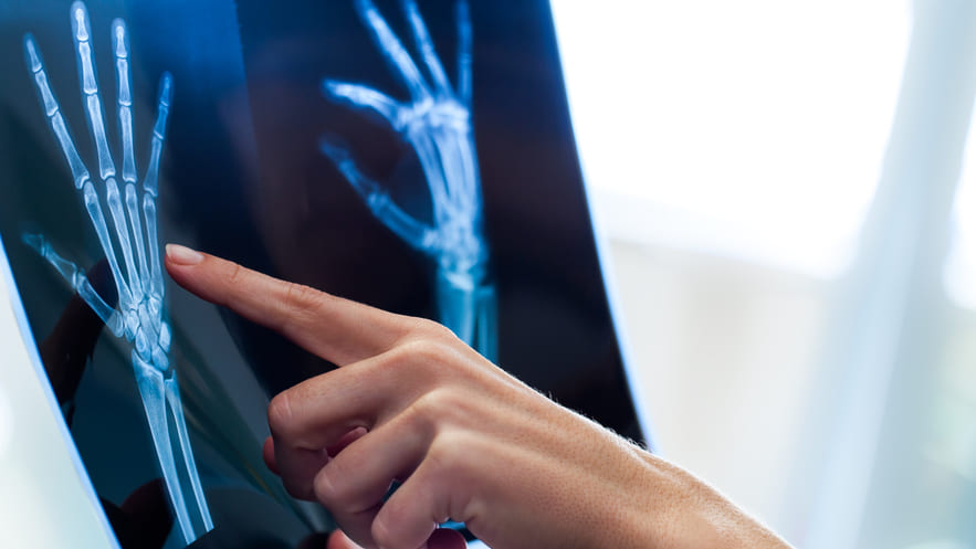 Показания к остеосинтезу пястной кости