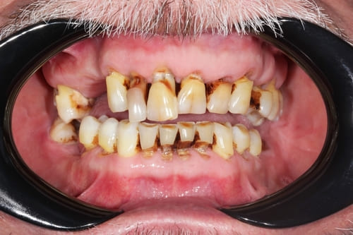 Хронический пародонтит