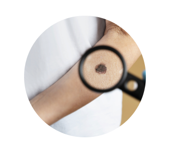 Биопсия родинки Биопсия родинки