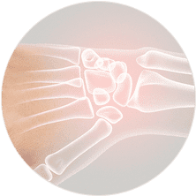 Остеосинтез костей запястья Остеосинтез костей запястья