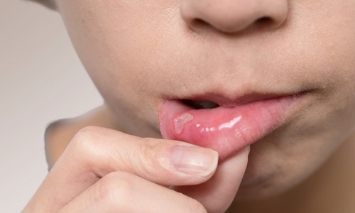 Герпетический стоматит