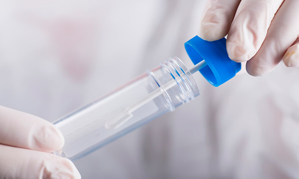 Анализ кала на стеркобилин Анализ кала на стеркобилин