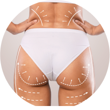 Липофилинг ягодиц