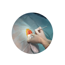 Вскрытие абсцесса бартолиновой железы