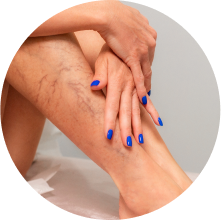 Лазерная коагуляция сосудов Лазерная коагуляция сосудов