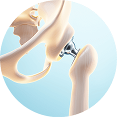 Эндопротезирование тазобедренного сустава Эндопротезирование тазобедренного сустава