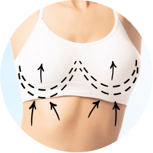 Подтяжка груди (мастопексия) Подтяжка груди (мастопексия)