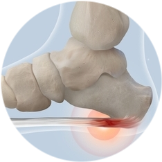 Удаление пяточной шпоры