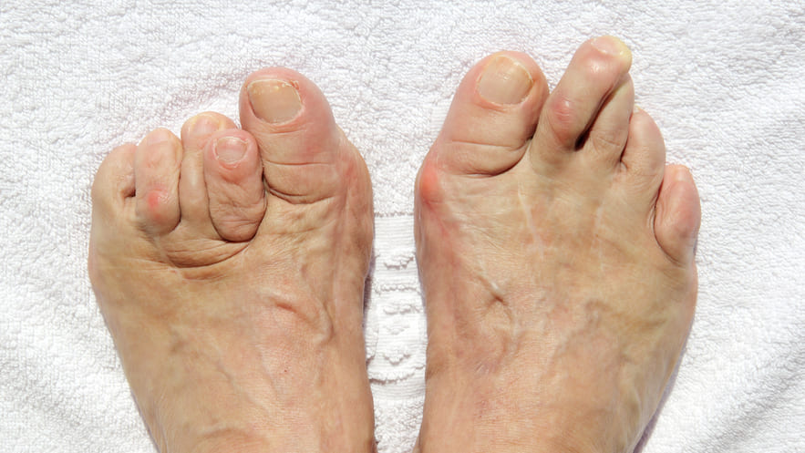 Молоткообразная деформация пальцев стопы Показания к остеотомии Вейля