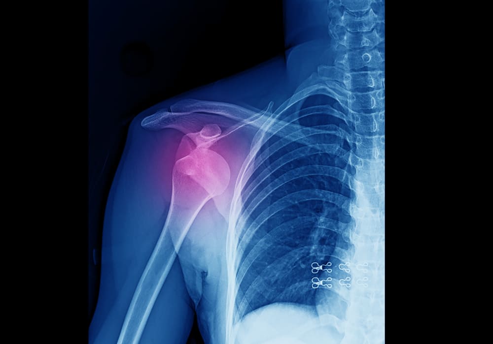 Показания к скелетному вытяжению