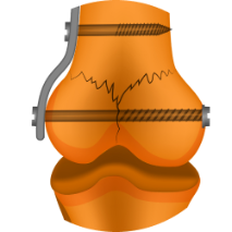 Остеосинтез надколенника Остеосинтез надколенника