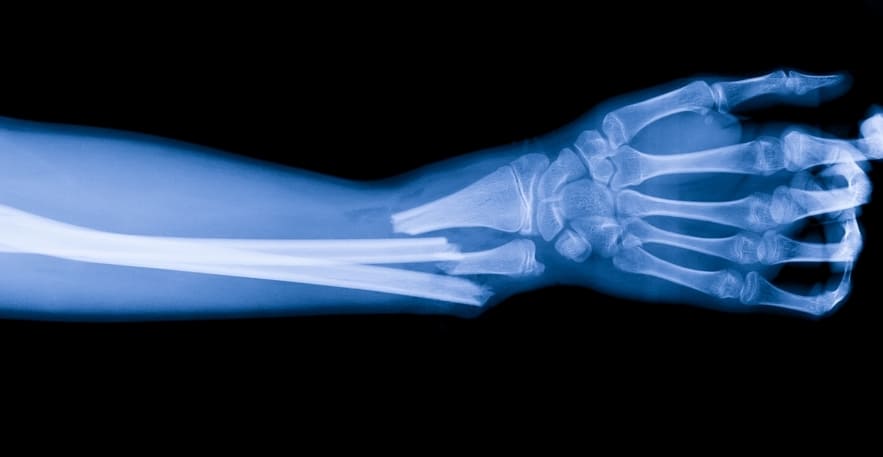 Перелом костей предплечья со смещением Показания к остеосинтезу костей