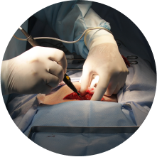 Стерилизация женщины