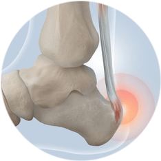Остеотомия пяточной кости